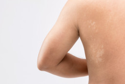 Pityriasis versicolor