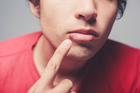 Infection de la peau par le virus Herpes simplex